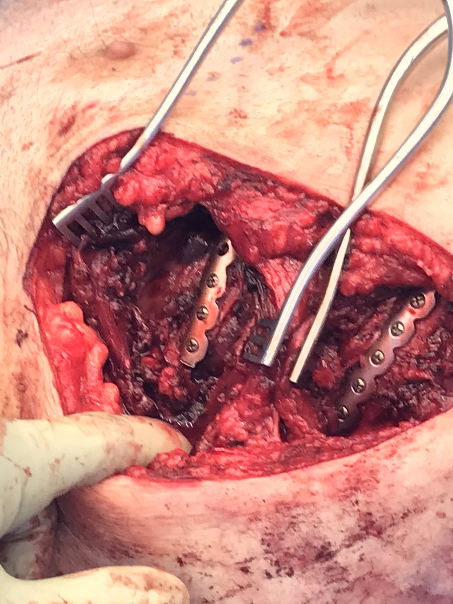 NKulvatunyou's tweet photo. Gratifying day teaching my PGYVI &amp; VII bilateral rib plating, reminding me of our previous fellow, Zach Bauman, DO #UNebraska who is now a rib plating expert #ribplating 🤓 https://t.co/D0roANSemB