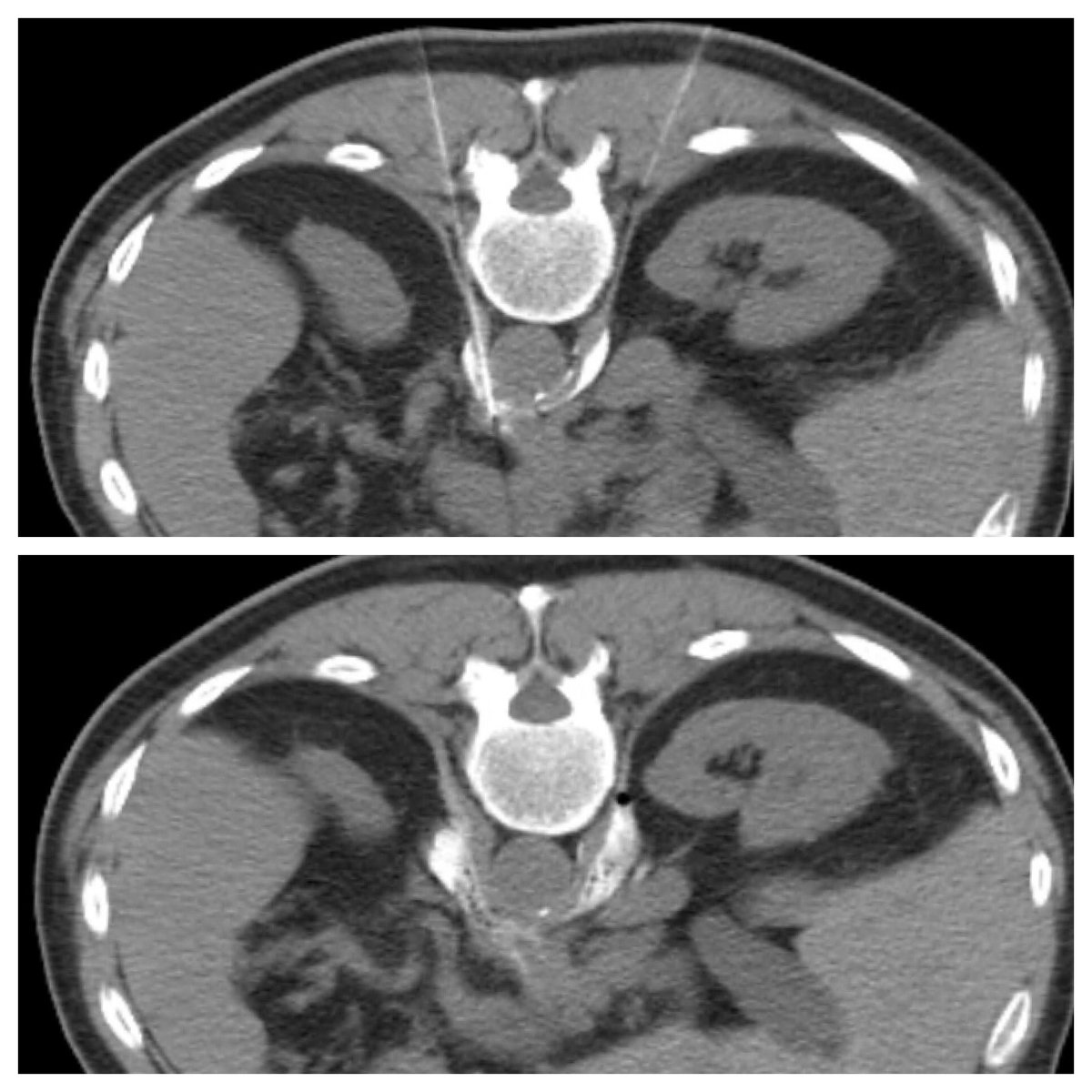 pparmetIR's tweet photo. 64 yo patient with intractable abdominal pain from pancreatic ca ... always amazed how such a simple procedure by #IRad can yield such robust pain relief and improved quality of life #celiacplexusblock #fightcancer @SIRspecialists @Synergyrad https://t.co/fbOW6FRuzD