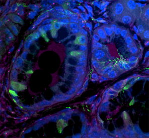 OxfordOncology's tweet photo. This image shows one of the earliest changes that can lead to development of cancer.
Find out how our scientists are working towards earlier diagnosis of #PancreaticCancer
🔬https://t.co/yzlSsmfWMW
#AdventCalendar #STEMadvent #CancerResearch https://t.co/MTAPa0j7V5