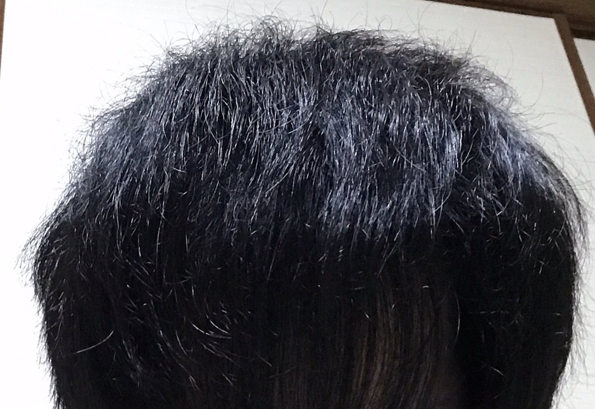 Agaアニキ ハゲていた身としては髪をすく ボリュームを落とす なんてもったいない と思ってしまって気が付いたらこんなにむさ苦しい頭になっていた 今からセルフカットしてみようと思う Aga ハゲ 若ハゲ Aga治療 薄毛 薄毛対策 薄毛改善 Agaアニキ ハゲていた身としては髪をすく ボリュームを落とす なんてもったいない と思ってしまって気が付いたらこんなにむさ苦しい頭になっていた 今からセルフカットしてみようと思う Aga ハゲ 若ハゲ Aga治療 薄毛 薄毛対策 薄毛改善