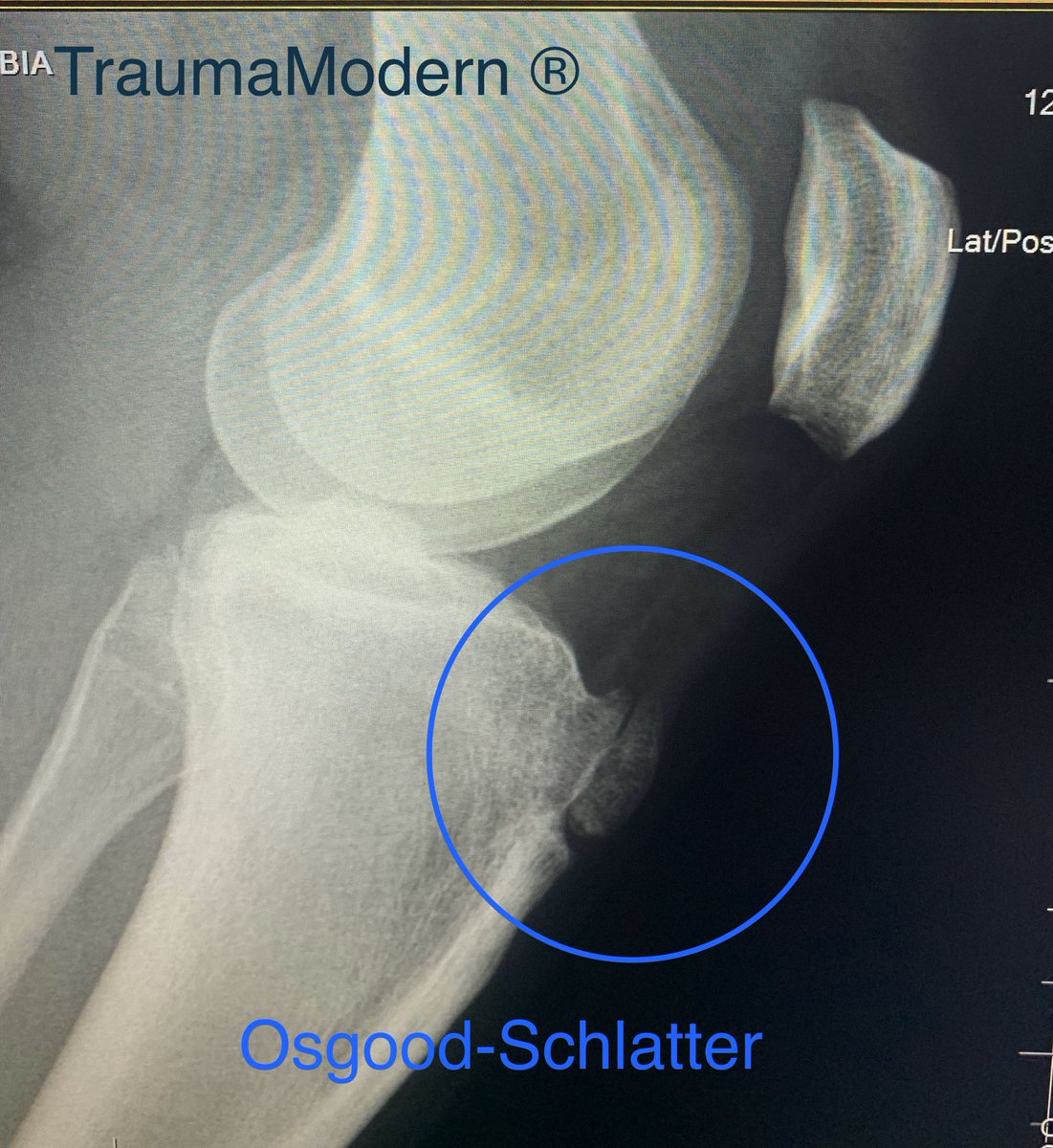 trauma_modern's tweet photo. Enfermedad-síndrome de #Osgood #Schlatter: causa de gonalgia en deportistas #jóvenes durante el crecimiento. La causa es la apofisitis-avulsión del tubérculo tibial por la tracción repetitiva del núcleo de osificación secundario de la tuberosidad tibial anterior. #traumamodern https://t.co/4U4PtMPlOU