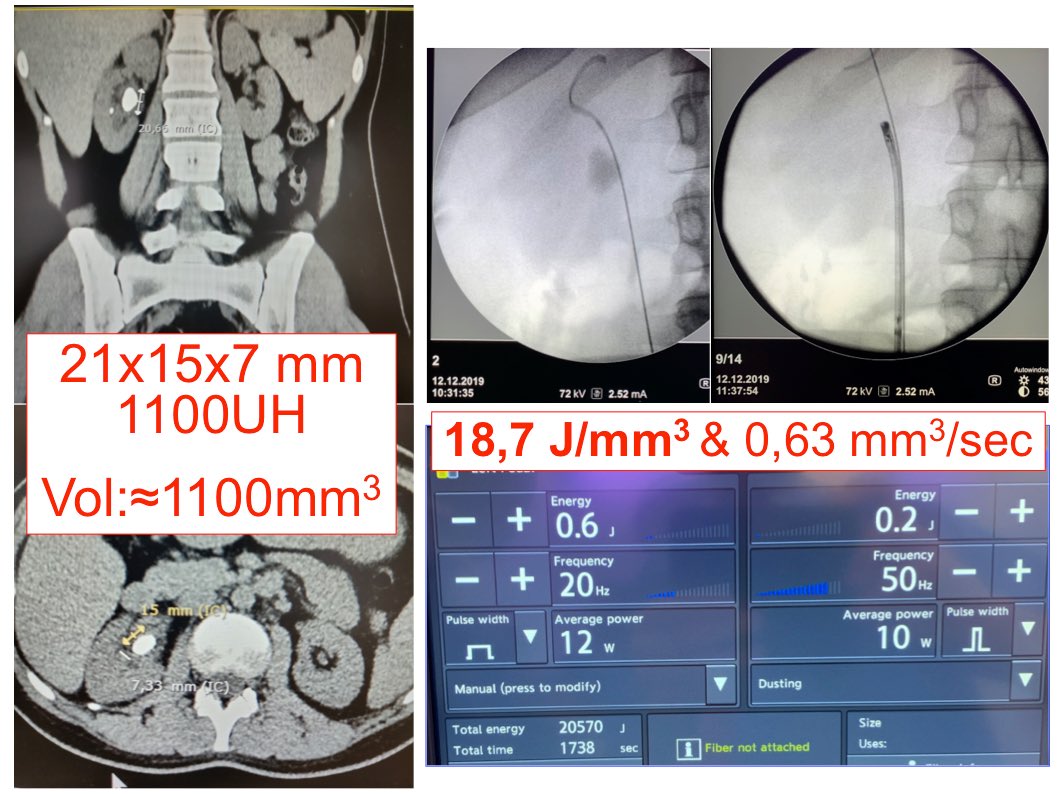 OTRAXER's tweet photo. BN13: « The J/mm3 » &amp; the « mm3/sec ». The best parameters to evaluate yourself with your laser technique. To evaluate improvements of Residents/Fellows &amp; to compare technologies : Ho:YAG vs TmFiber. Be brave &amp; Just report your personnal data! https://t.co/YxhPFTnZdt