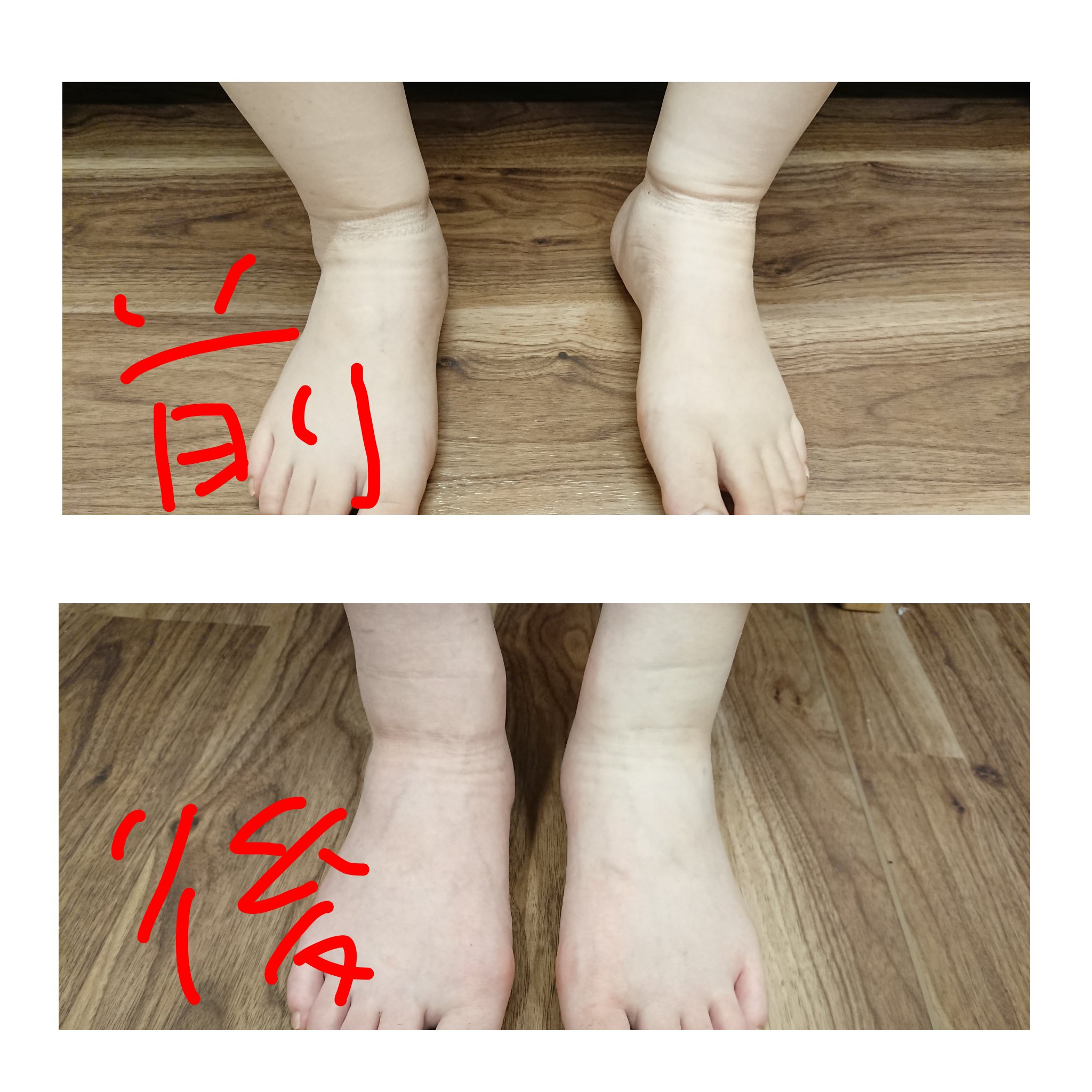 西口 由美 骨盤ケア産科ナース على تويتر 産後のむくみがつらい 足の甲までパンパン そんなママの足のむくみの悩みは ホルモンバランスの変化や 体内を巡る血液 水分量の変化によって起こります 今日は そんなママに 自分でできるマッサージを