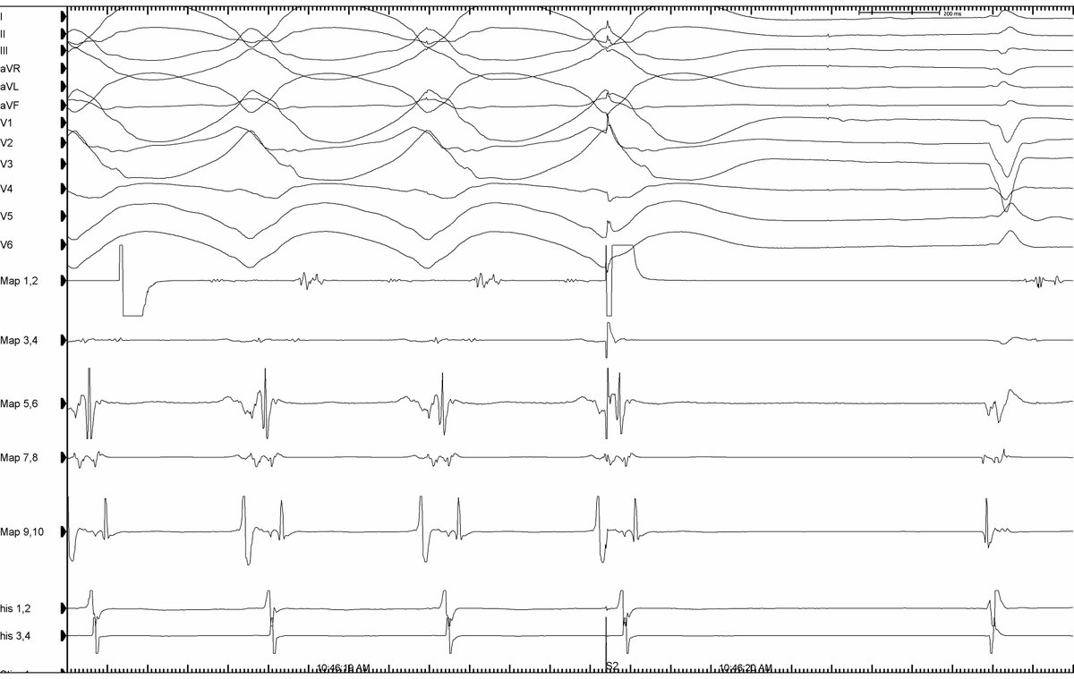 Asad (@epabouda) on Twitter photo #EPeeps, #EPFellows, case with <a href="/ep_travis/">Travis Richardson</a>, @wgste How do you interpret this response?<a href="/DrGregMichaud/">Gregory Michaud</a> <a href="/jaymontgomery44/">Jay Montgomery</a> <a href="/ArvindhKana/">Arvindh Kanagasundram</a> <a href="/JuliaMcHugh10/">Julia McHugh</a> <a href="/GDavogustto/">Giovanni Davogustto</a> <a href="/10HolmesDrop/">Benjamin Holmes, MD</a> @BCHt @VUMC_heart #EPeeps, #EPFellows, case with <a href="/ep_travis/">Travis Richardson</a>, @wgste How do you interpret this response?<a href="/DrGregMichaud/">Gregory Michaud</a> <a href="/jaymontgomery44/">Jay Montgomery</a> <a href="/ArvindhKana/">Arvindh Kanagasundram</a> <a href="/JuliaMcHugh10/">Julia McHugh</a> <a href="/GDavogustto/">Giovanni Davogustto</a> <a href="/10HolmesDrop/">Benjamin Holmes, MD</a> @BCHt @VUMC_heart