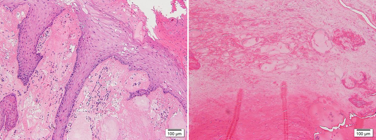 Dermpathl's tweet photo. Perforating gouty tophus with cutaneous horn formation. Skin of heel of a man in his 60s. #dermpath #pathology #dermatology https://t.co/G1ZSszWImF