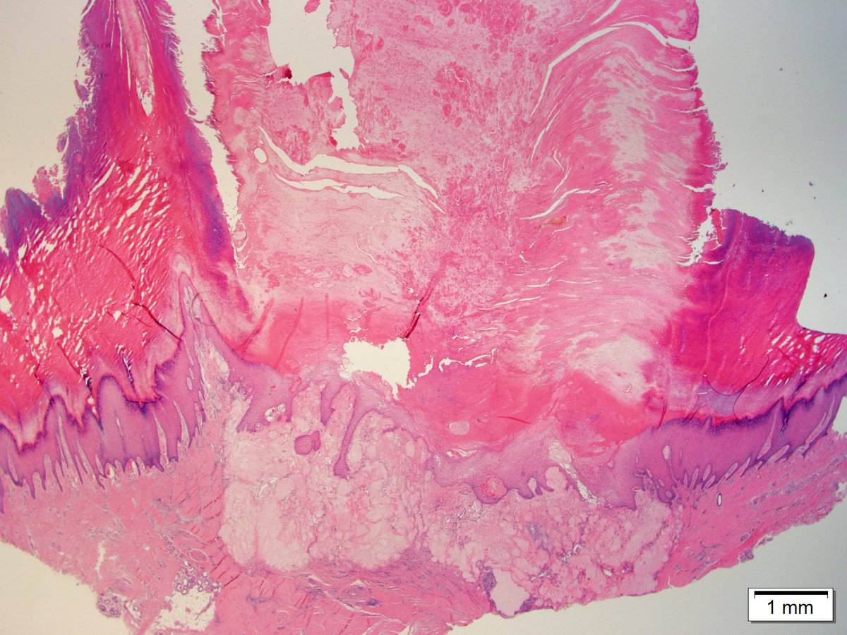 Dermpathl's tweet photo. Perforating gouty tophus with cutaneous horn formation. Skin of heel of a man in his 60s. #dermpath #pathology #dermatology https://t.co/G1ZSszWImF