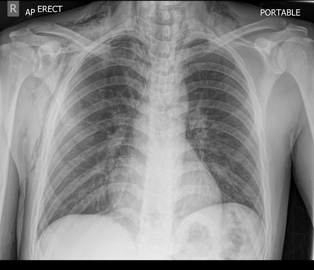 thexraydoctor's tweet photo. Gas everywhere following oesophageal tear
https://t.co/WNEFIBZIny
#xrayoftheweek #FOAMRad #FOAMed #meded #radres #radreg #medtwitter https://t.co/WVrVAKoRuu