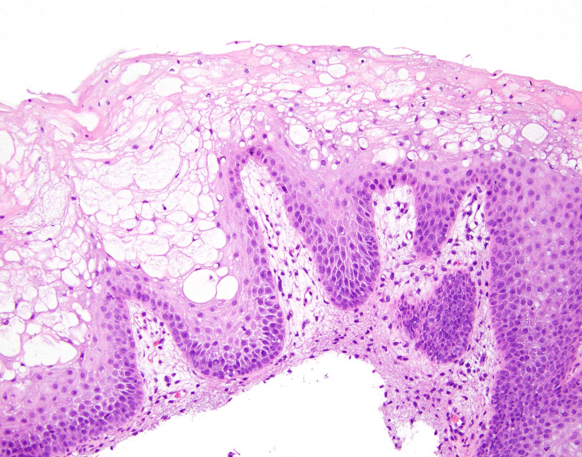This is an incidental finding overlying an anal fibroepithelial polyp.  It is termed "pagetoid dyskeratosis" but it is simply reactive.  The same finding is known in prolapsed uterine cervices. A few GI Survival Guides are still around.  Try innovativesciencepress.com