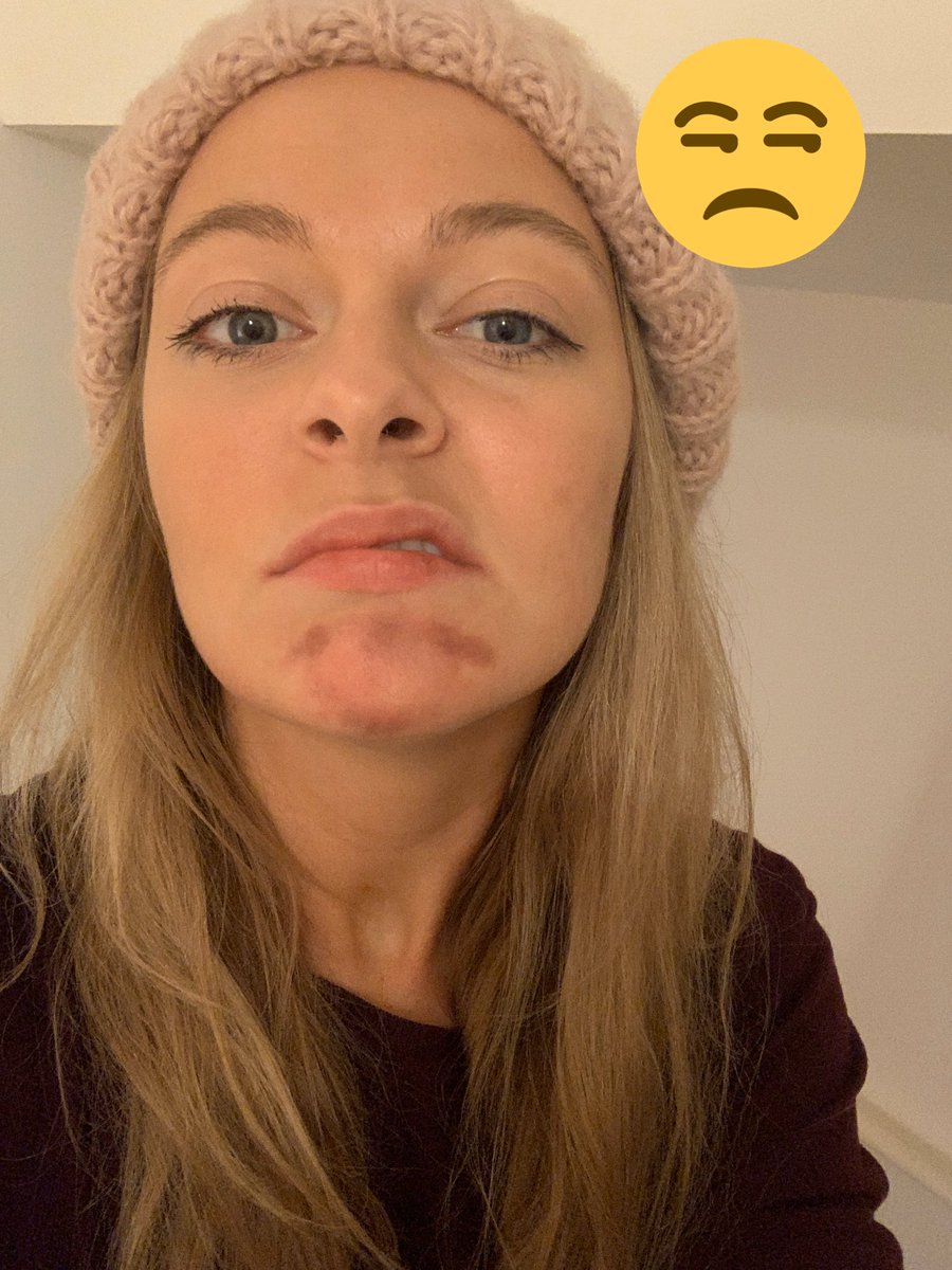 greerrankin's tweet photo. @gregjmchugh Right. When you fire that explosive hingymajig gun with the riveting, unraveling ribbons of destruction, goin’ just not hit me in the face again, eh? Cheers on an otherwise brilliant Panto! 
#preexistingbruise #joke #yourribbongundidhitmethoughbutdidntleaveamarklucky https://t.co/kuHko5jyi8