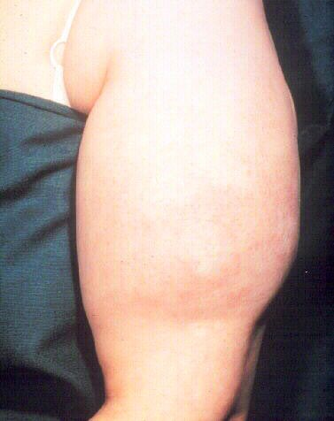 الزاوائد الجلدية واسوداد الجلد من علامات #مقاومة_الإنسولين التي تبدأ في الظهور أحيانا حتى قبل إمكاني...