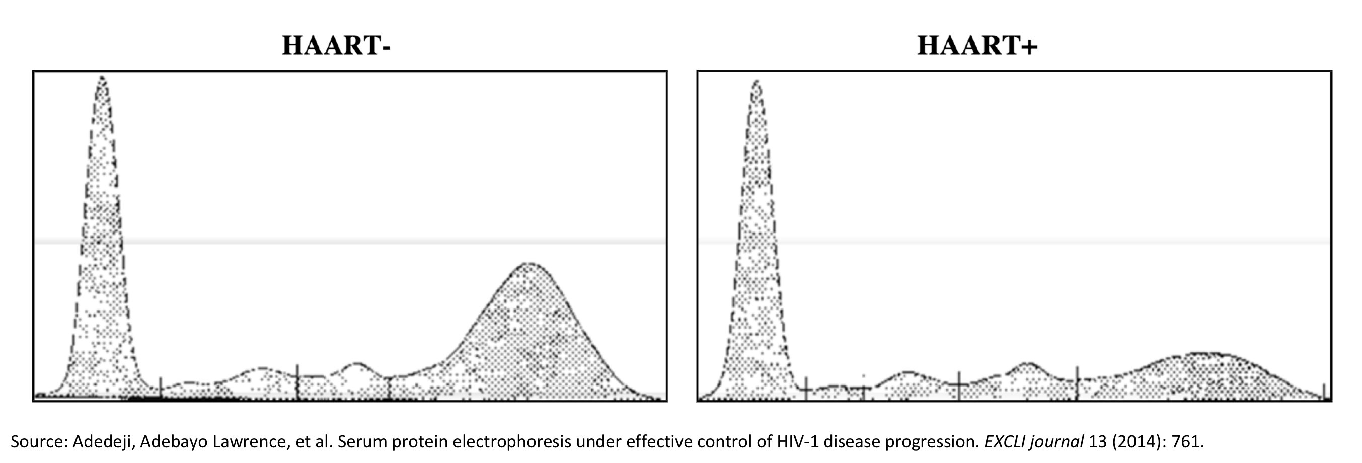 Tony Breu on Twitter "1/13 Why does HIV cause an elevated protein gap