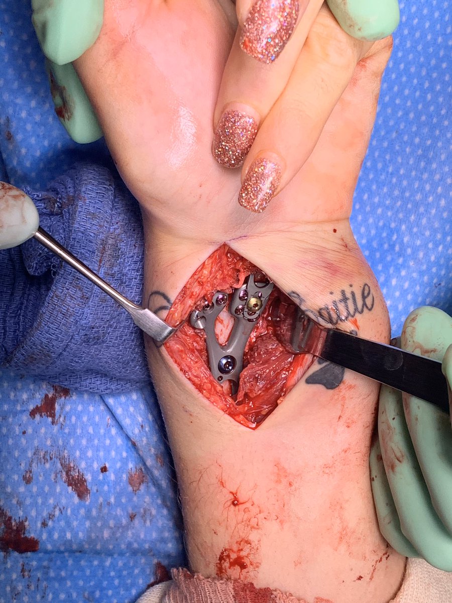 officalchtky's tweet image. Example of a volar plate  for a distal radius fracture intraoperative. These plates are extremely strong and have great contouring of bone to allow early motion and avoid wrist and digital stiffness. Active range of motion can start at three days post surgery.