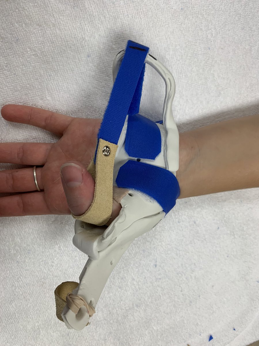 officalchtky's tweet image. Static progressive hand-based orthotic to slowly elongate stiffness of the MP joint status post UCL ligament injury