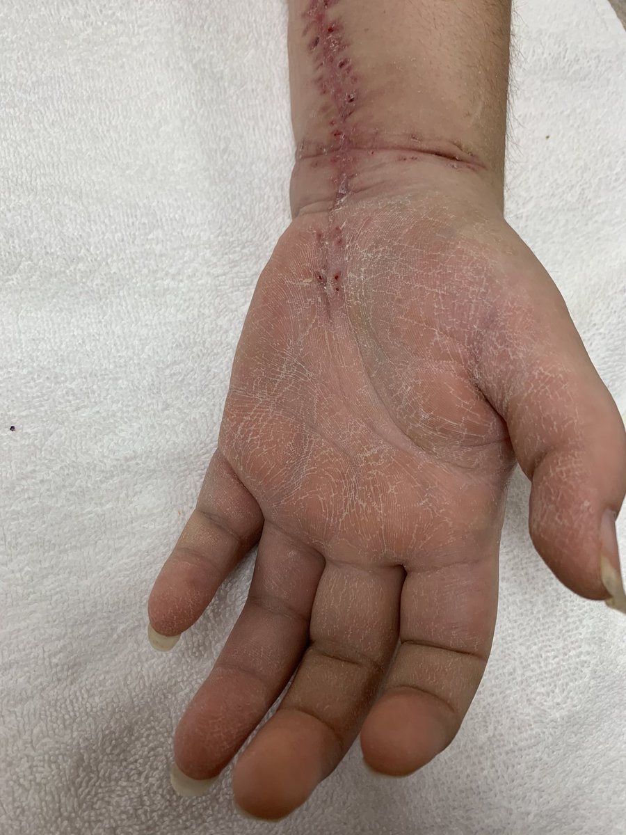 officalchtky's tweet image. Status post laceration of all flexor tendons median nerve and ulnar nerve. Notice autonomic trophic changes evidenced by drying of skin in the palm of her hand.