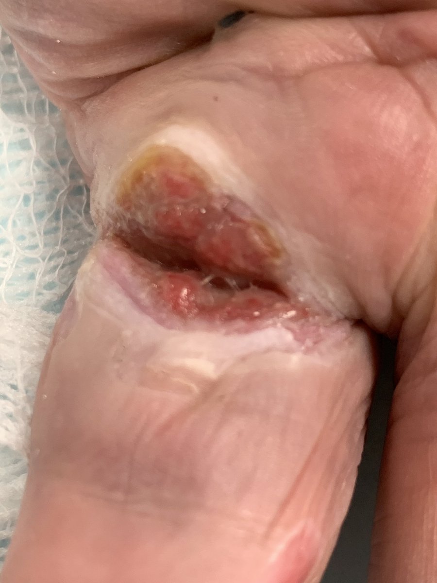 officalchtky's tweet image. Progressive healing status post injection to correct Dupytrens contracture . Of interest noticed cross bridging of epithelial tissue attempting to create a contracture of the wound.