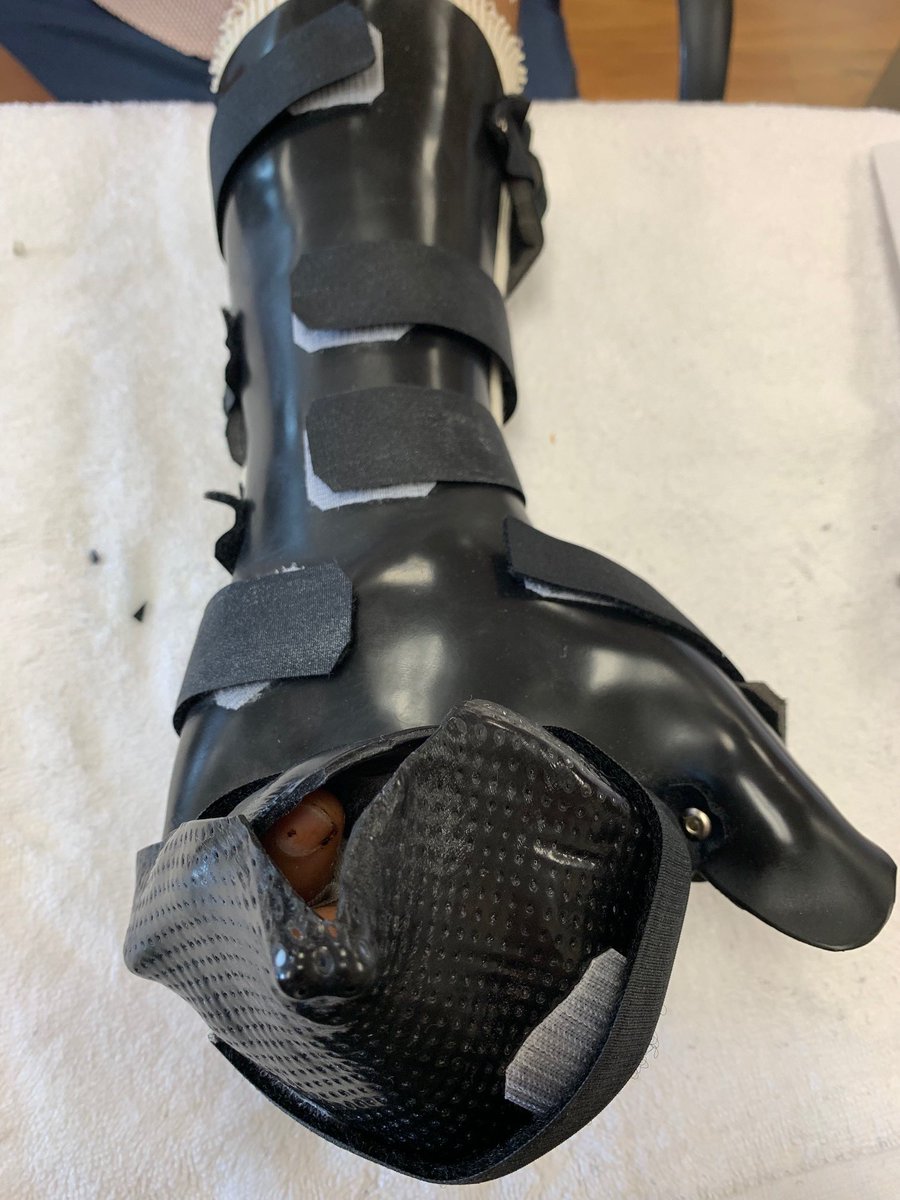 officalchtky's tweet image. Protective Orthotic status post midmetacarpal replantation. Splint is carefully adjusted to control blood flow and protect replanted digits.