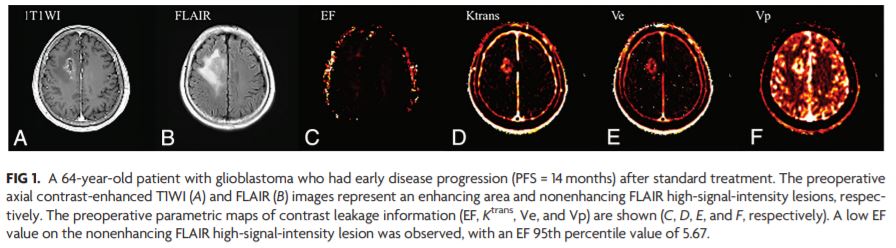 TheAJNR's tweet photo. "Prognostic Predictions for Patients with Glioblastoma after Standard Treatment: Application of Contrast Leakage Information from DSC-MRI within Nonenhancing FLAIR High-Signal-Intensity Lesions" | #MRperfusion | https://t.co/8k8gyP8nyM https://t.co/j3EbTPgyMX