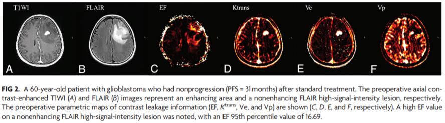 TheAJNR's tweet photo. "Prognostic Predictions for Patients with Glioblastoma after Standard Treatment: Application of Contrast Leakage Information from DSC-MRI within Nonenhancing FLAIR High-Signal-Intensity Lesions" | #MRperfusion | https://t.co/8k8gyP8nyM https://t.co/j3EbTPgyMX