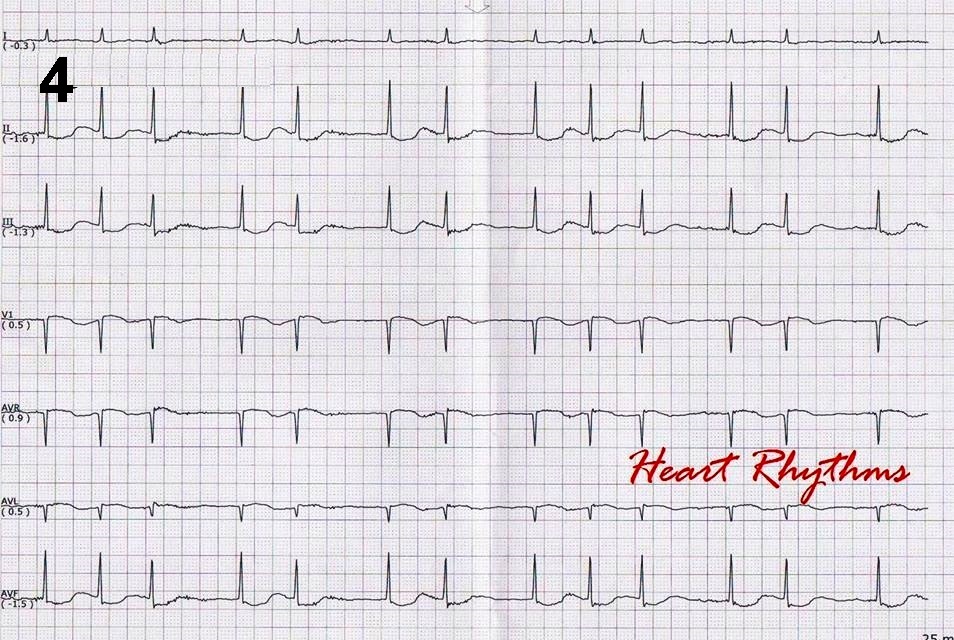 1/The 4 image twitter rapid ecg dx

1-Laddergram pls
2-Pacemker malfx? Y/N
3-Name the QRS complex on arrow
4-Pt admit for confusion. CT brain - sroke. The drug level was elevated. ECG diagnosis and dx for confusion?

#FOAMed #FOAMems #meded #cardiology #cardiotwitter #EPeeps