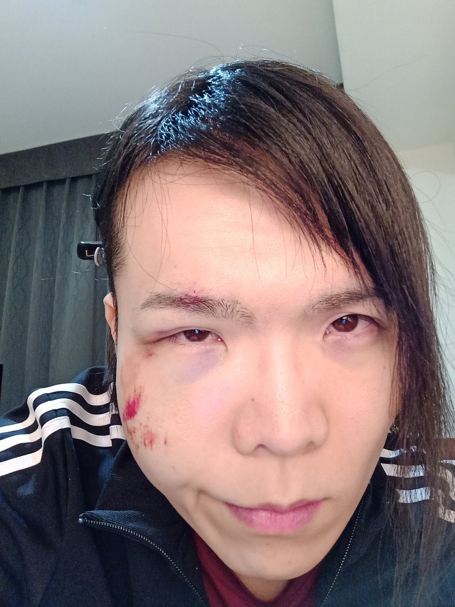 がそ宮りんこ がそりんチャンネルの中の人系バーチャルユーチューバー Pa Twitter グロ注意 がそりんチャンネルディレクターがそdのケガの現状 なんとか出血は止まるも片側腫れすぎて目が開かないし口も引きっつて動かないし強打しすぎて頭クラクラするし がそ宮りんこ がそりんチャンネルの中の人系バーチャルユーチューバー Pa Twitter グロ注意 がそりんチャンネルディレクターがそdのケガの現状 なんとか出血は止まるも片側腫れすぎて目が開かないし口も引きっつて動かないし強打しすぎて頭クラクラするし