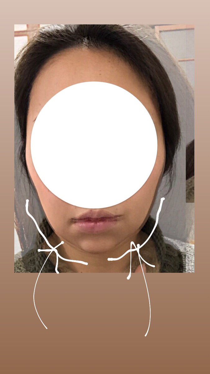 Sana 背術前と18日目 わかりづらいですが 若干下頬のとこが細くなってるのわかります 下顎の方より 左右の横幅が狭くなってる バッカルファットを少し除去したからかな 脂肪吸引 韓国整形 キツネライン