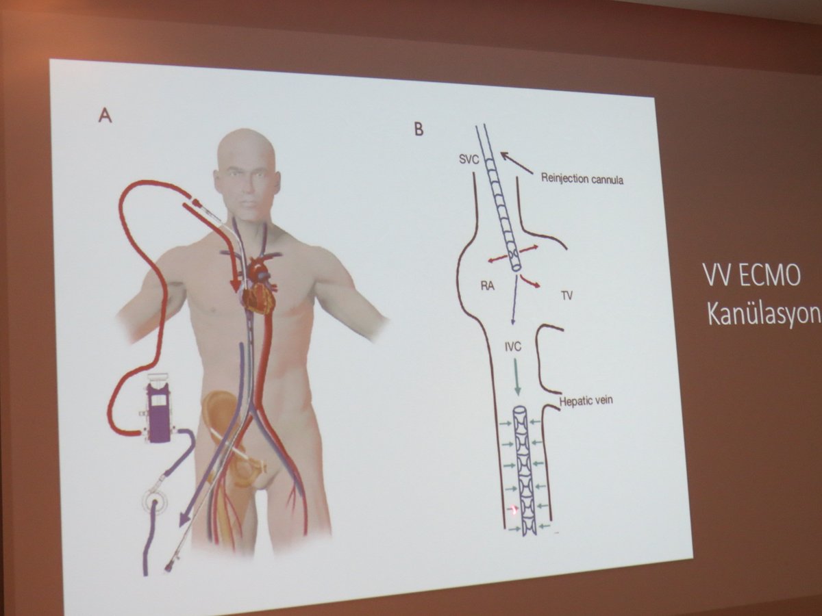 atuder1999's tweet photo. https://t.co/Hopro8rScs
📍K A P A T O K S - 3 Ankara
🗓️28 - 29 Aralık 2019
Dr. Öğrt. Üyesi Yunus Emre ÖZLÜER 👉" ECMO " konulu sunumunu yapıyor. #atuder #epat #acil #ecmo #toksikoloji #yeps https://t.co/iPC5iNVx0w