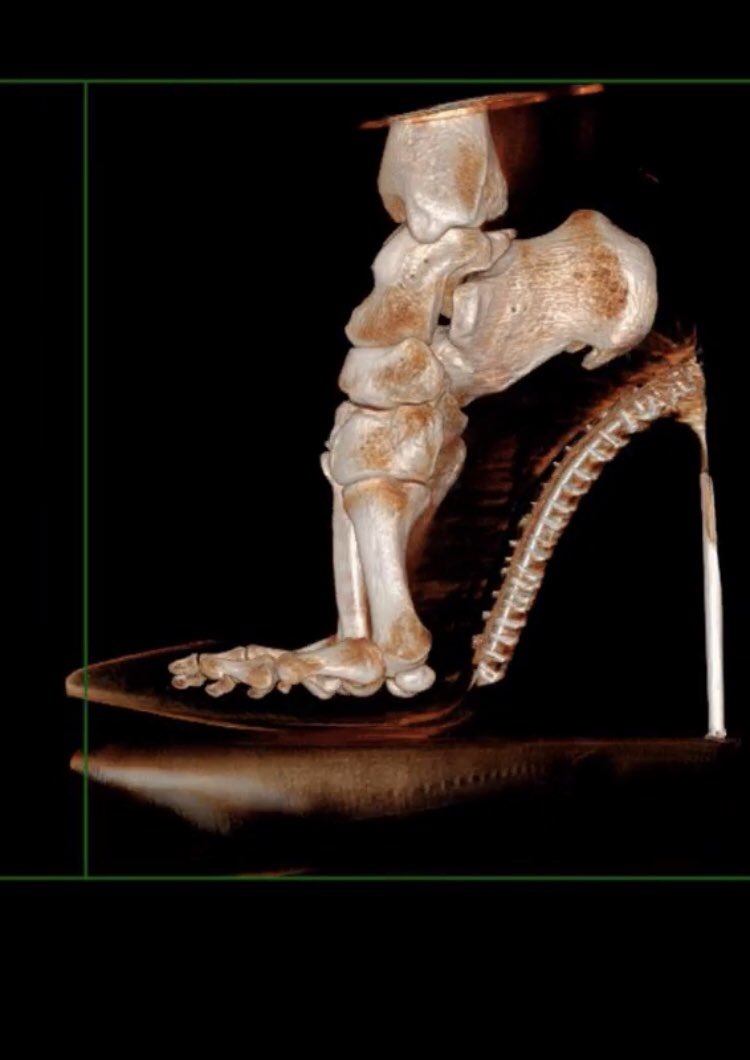 Wowsers!!!

Walking on high heels 💃🏻 #PEDscan #begentle #feet