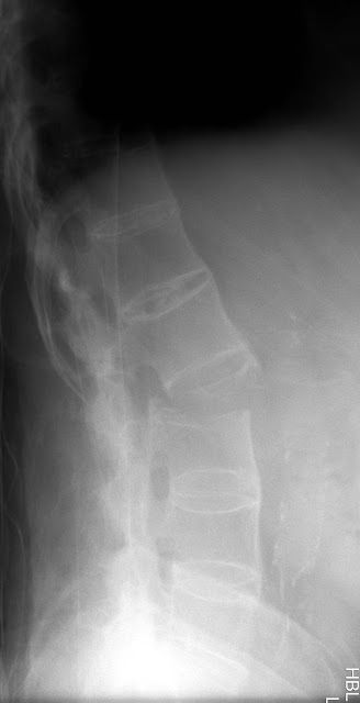 thexraydoctor's tweet photo. Chalkstick fracture in ankylosing spondylitis
https://t.co/MGWnbcBOIx
#xrayoftheweek #FOAMRad #FOAMed #meded #radres #radreg #medtwitter https://t.co/H1tD9YKpyY