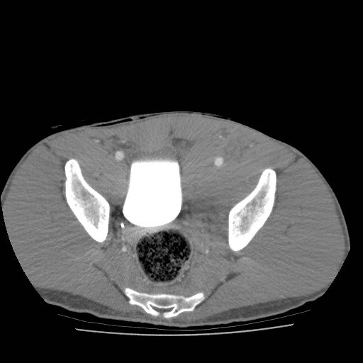 thexraydoctor's tweet photo. 🍐Pear bladder sign due to pelvic haematoma
https://t.co/JAQFj5wTyX
#xrayoftheweek #FOAMRad #FOAMed #meded #radres #radreg #medtwitter https://t.co/fNoPKOtlOw