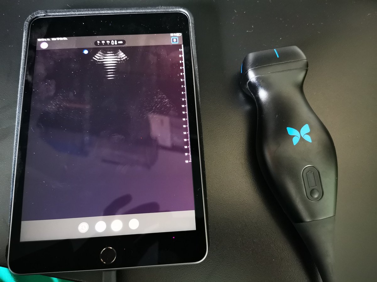 Doing PCNL in supine with our new ultrasound portable probe Butterfly-IQ. <a href="/HugoLopezRamos/">Hugo Lopez Ramos</a> <a href="/UrologiaPUJ/">Urologia Javeriana</a> #UroSoMe #urology #PCNL #endourology #kidneystones