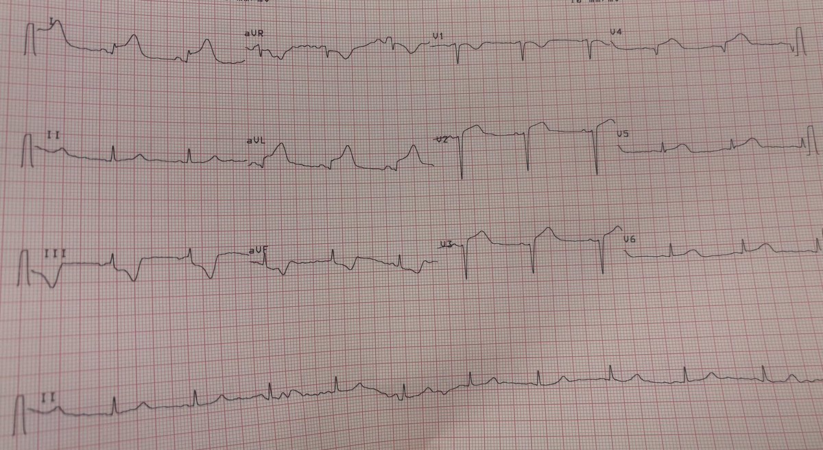 gonzaeperez's tweet photo. 42yo 👩🏻‍🦰 smoking. Anaphylaxis due to champagne ingest. BP 80/60. Chest Pain. 
Diagnosis ? 
What do you do? 
@smithECGBlog @EM_RESUS @Dr_DanMD @jpcostabel @edurontoFF @ShariqShamimMD https://t.co/mliHQzI32b
