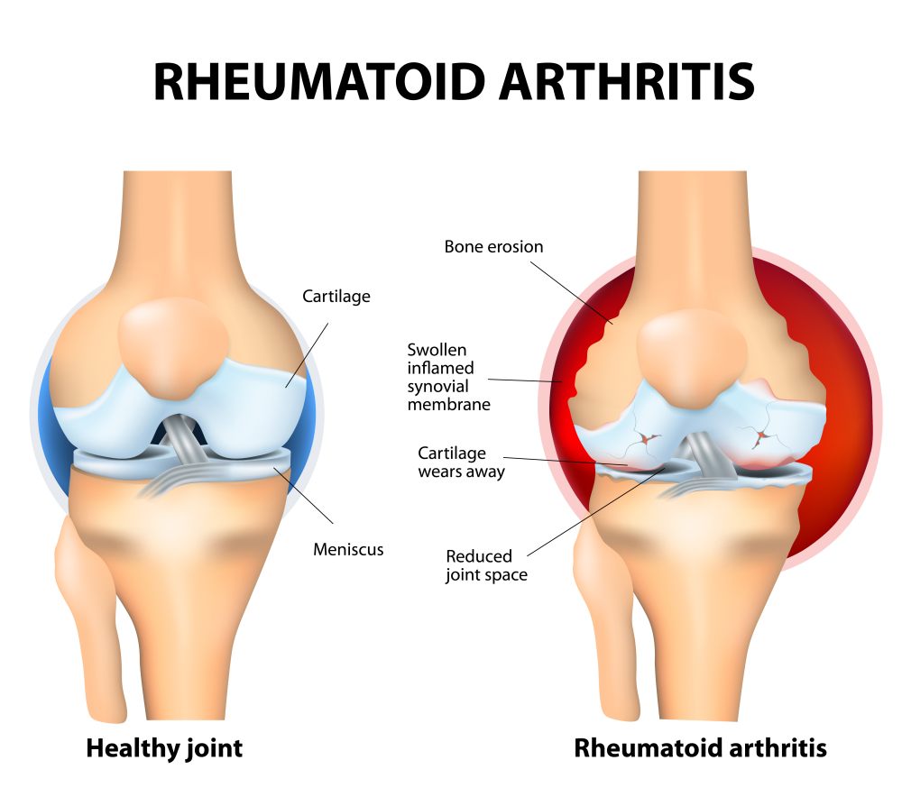 MDedge Rheumatology tweet media