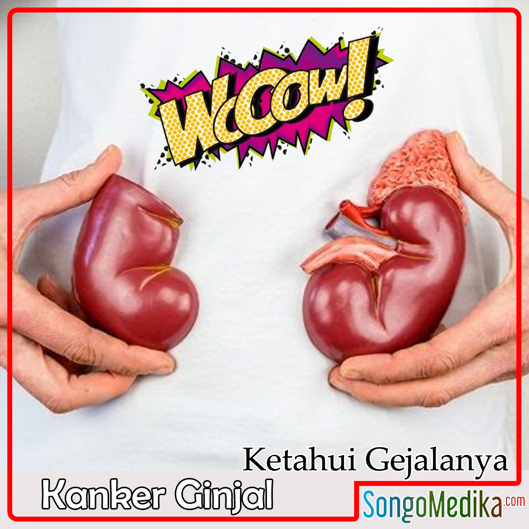 songomedika's tweet photo. Kanker ginjal kira-kira seperti apa gejalanya :
1. Demam
2. Berkeringat di malam hari
3. Penurunan berat badan
4. Tekanan darah tinggi
5. Kekurangan darah
6. Nyeri dan bengkak di sekitar punggung bawah dan pinggang
#kanker #kankerginjal #ginjal #kankerstadium3 #infosehat https://t.co/ibZcnkDPBF