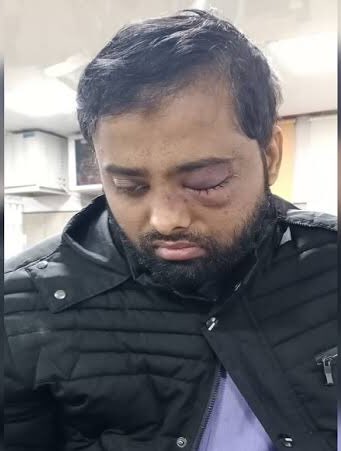 Sonal_MK's tweet photo. That’s the face of #JamiaProtests 

26yrold LLM student was preparing for his exam at the library when @DelhiPolice stormed in.

What happened next, ruptured his cornea, he lost an eye and now a surgery will be required to save the other one. 

Who answers him? #CAAProtest https://t.co/mBn4ALIjNh
