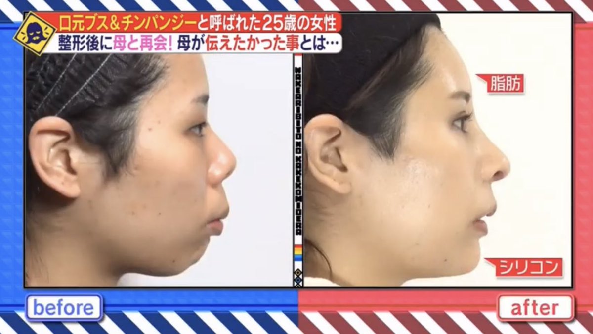 ごぼ美 On Twitter 本人が満足してるならそれが全てということを大前提に 今回の症例を見て思ったこと 目と鼻は欲張ると人工物感が凄い 人中が長い人は二重幅を広くするとかえって面長感が増す セラミック歯は根本解決にはならない可能性あり 可能な限り歯列