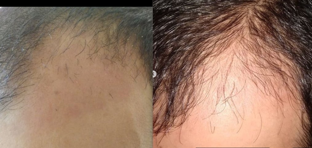 Bitkilerin Gücüne Herkes Şahit Olsun , %100 bitkisel yöntemle aradaki fark ortada.

#mucizedoktor #mucizeadam #mavisu #mavilosyon #uraw #biohira #bitkisel #organik #saçsorunu #mucizeserum #istanbul #adana #mersin #ankara #bursa #izmir #silivri #antalya #beylikdüzü #şişli