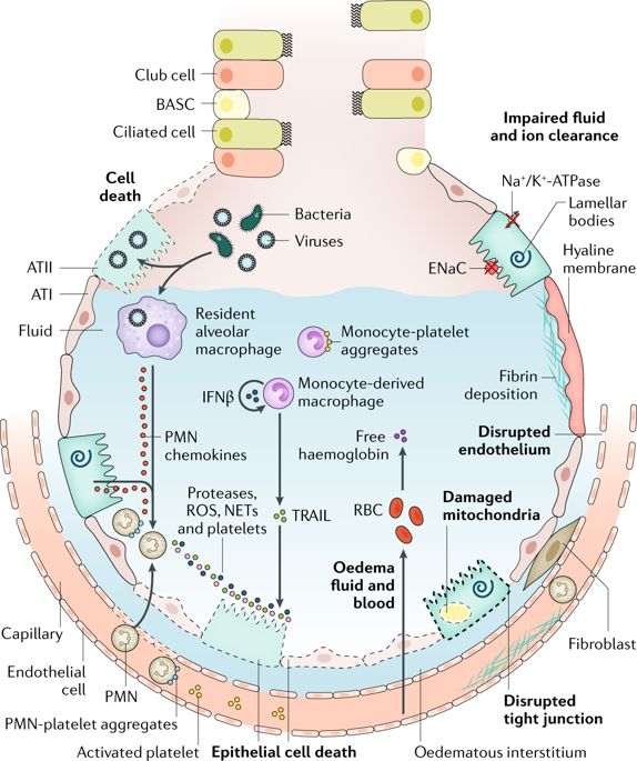 Pneumonia And Sepsis Pneumonia 2020