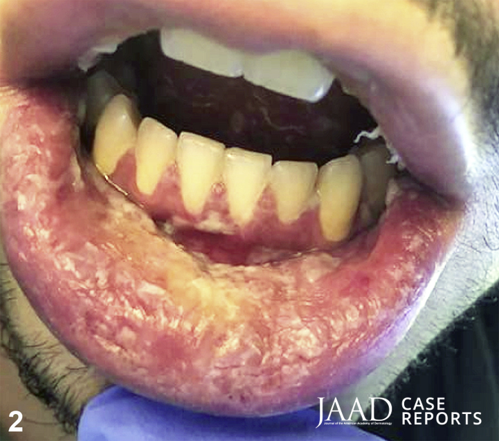JAADjournals's tweet photo. CME Case Challenge: What's the diagnosis?

A. Mycoplasma pneumoniae-induced rash and mucositis
B. Pyostomatitis vegetans
C. Pemphigus vulgaris
D. Mucous membrane pemphigoid
E. Drug-induced Stevens-Johnson syndrome

Claim CME credit for answering here: https://t.co/ln54oNMfGn https://t.co/Xl8vONI9WX