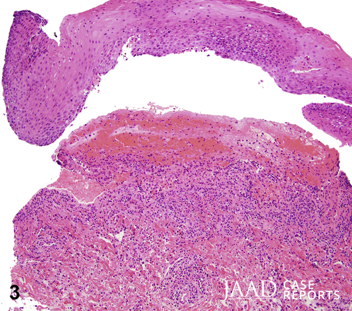 JAADjournals's tweet photo. CME Case Challenge: What's the diagnosis?

A. Mycoplasma pneumoniae-induced rash and mucositis
B. Pyostomatitis vegetans
C. Pemphigus vulgaris
D. Mucous membrane pemphigoid
E. Drug-induced Stevens-Johnson syndrome

Claim CME credit for answering here: https://t.co/ln54oNMfGn https://t.co/Xl8vONI9WX