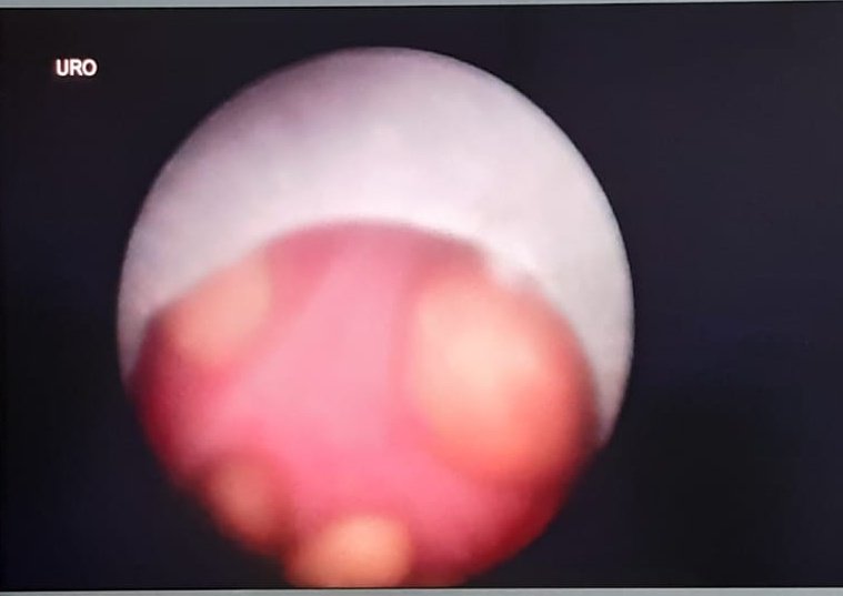 VcntKno's tweet image. Our 4th #USGuided #Mini #PCNL 
☢🆓️
👩🏻16yo prior #FUS w/a lot of residual fragments in other hospital. #Fecal4 #DJ after 8mo

@SeplouMedical w/18Fr disposable sheath. @EndoscopiaGDL @SamsungMexico

@UroMIDT1 @VillaRR20 @ozkr_tvz @CMUN_ColMexU @eulis_uroweb @CAU_URO @EMSUrology