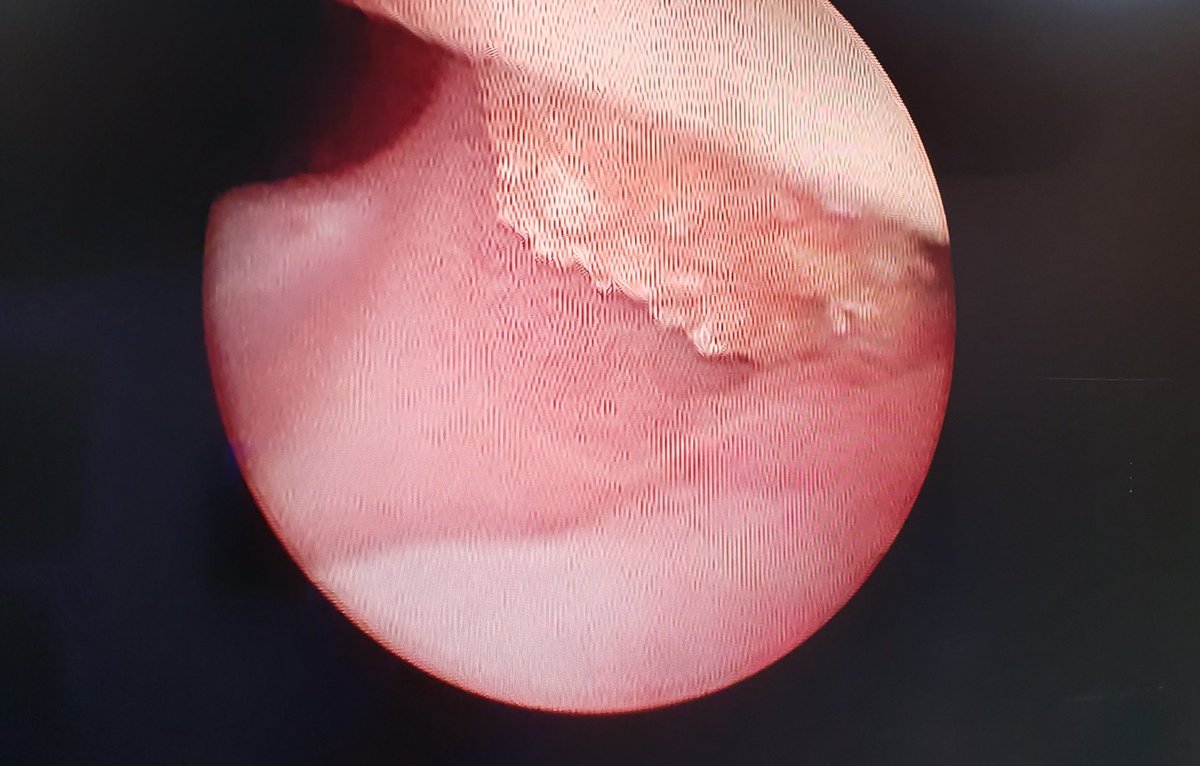 VcntKno's tweet image. Our 4th #USGuided #Mini #PCNL 
☢🆓️
👩🏻16yo prior #FUS w/a lot of residual fragments in other hospital. #Fecal4 #DJ after 8mo

@SeplouMedical w/18Fr disposable sheath. @EndoscopiaGDL @SamsungMexico

@UroMIDT1 @VillaRR20 @ozkr_tvz @CMUN_ColMexU @eulis_uroweb @CAU_URO @EMSUrology