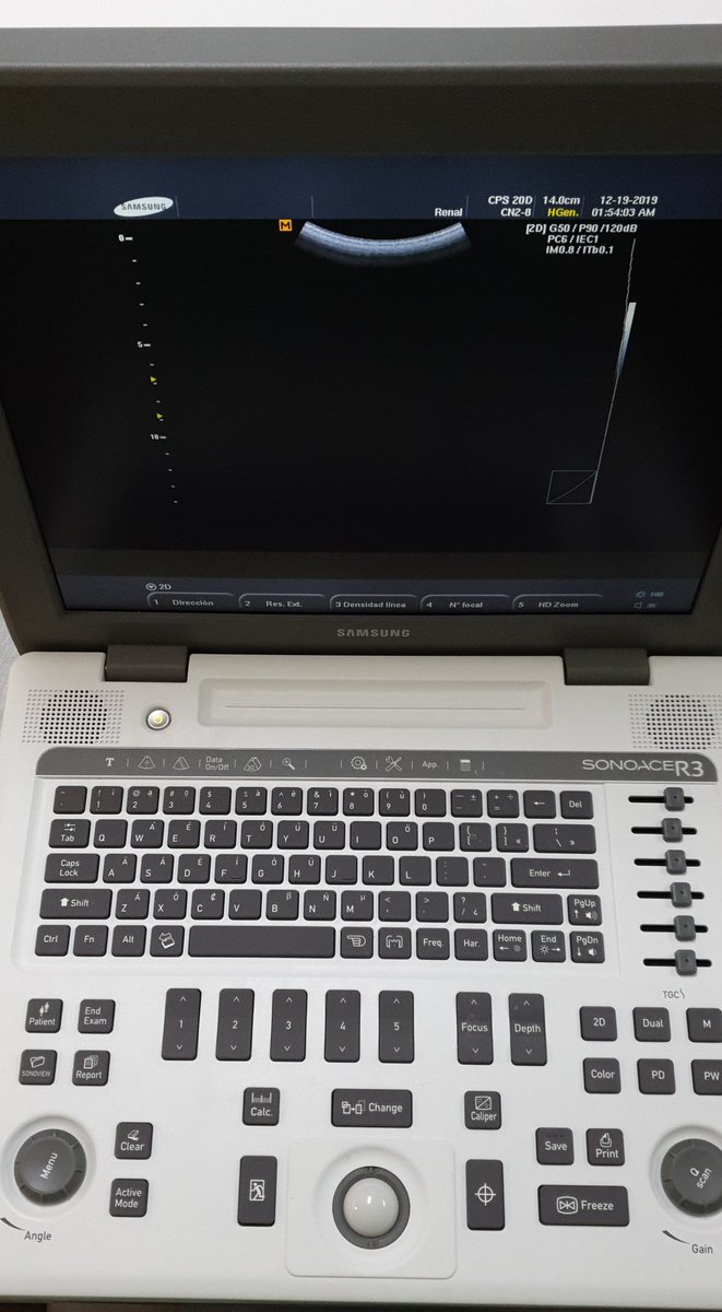 VcntKno's tweet image. Our 4th #USGuided #Mini #PCNL 
☢🆓️
👩🏻16yo prior #FUS w/a lot of residual fragments in other hospital. #Fecal4 #DJ after 8mo

@SeplouMedical w/18Fr disposable sheath. @EndoscopiaGDL @SamsungMexico

@UroMIDT1 @VillaRR20 @ozkr_tvz @CMUN_ColMexU @eulis_uroweb @CAU_URO @EMSUrology