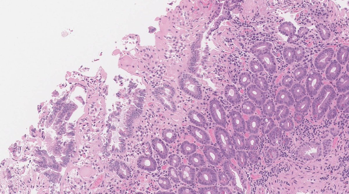 RunjanChetty's tweet photo. 48 year old male with multiple "fibrotic" areas in the duodenum on endoscopy and also noted at prior lap cholecystectomy for gallstones. He had NO GI symptoms. This is a duodenal biopsy H&Es and Masson's trichrome. https://t.co/6dI0RKFfki