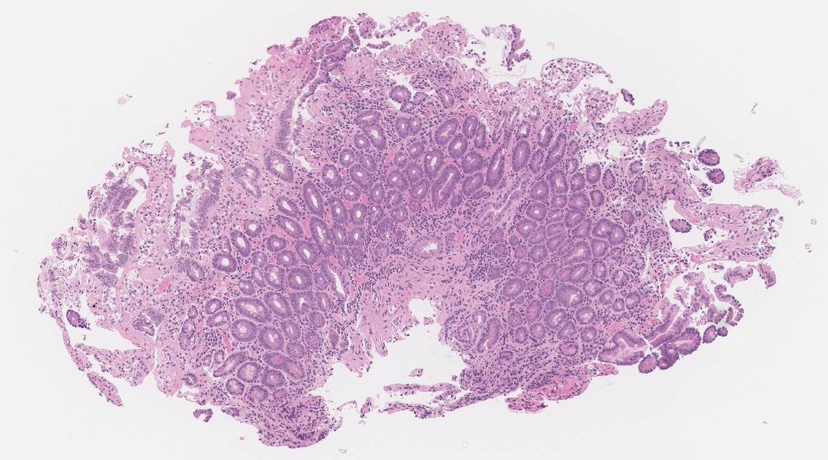 RunjanChetty's tweet photo. 48 year old male with multiple "fibrotic" areas in the duodenum on endoscopy and also noted at prior lap cholecystectomy for gallstones. He had NO GI symptoms. This is a duodenal biopsy H&Es and Masson's trichrome. https://t.co/6dI0RKFfki