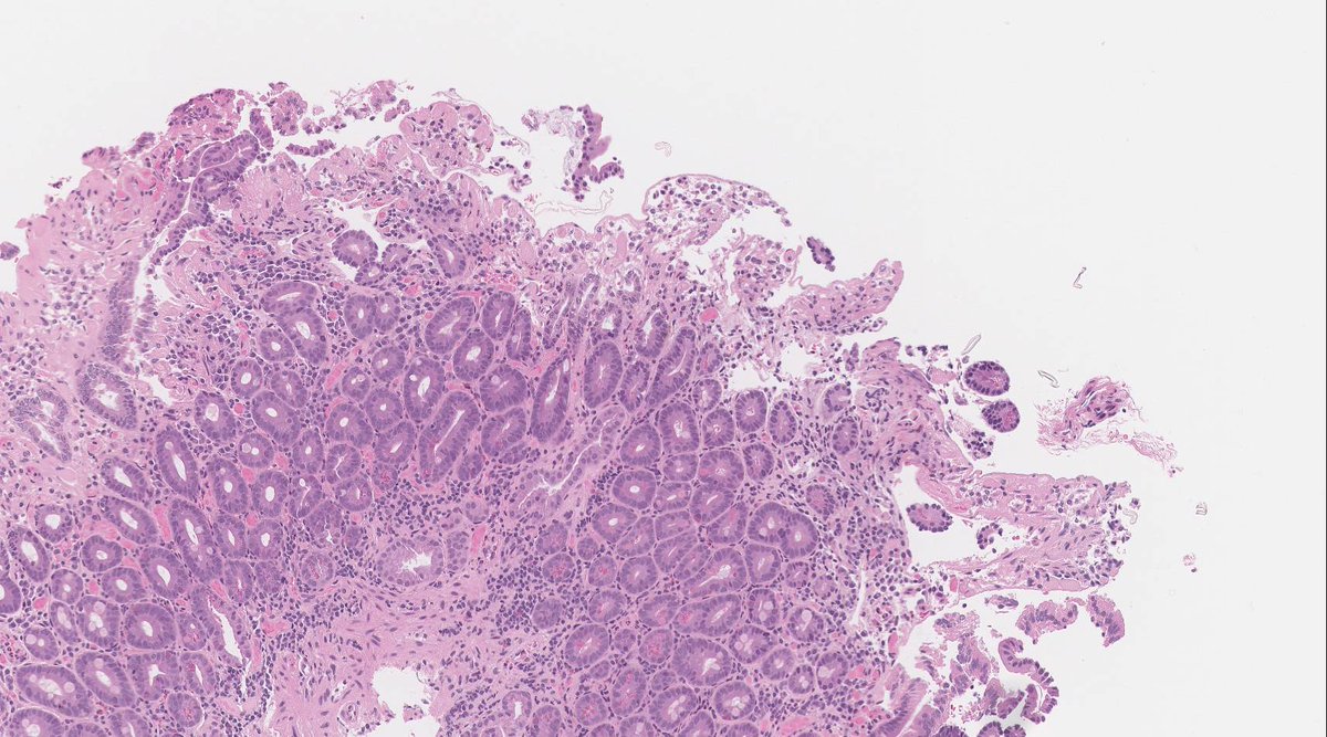 RunjanChetty's tweet photo. 48 year old male with multiple "fibrotic" areas in the duodenum on endoscopy and also noted at prior lap cholecystectomy for gallstones. He had NO GI symptoms. This is a duodenal biopsy H&Es and Masson's trichrome. https://t.co/6dI0RKFfki