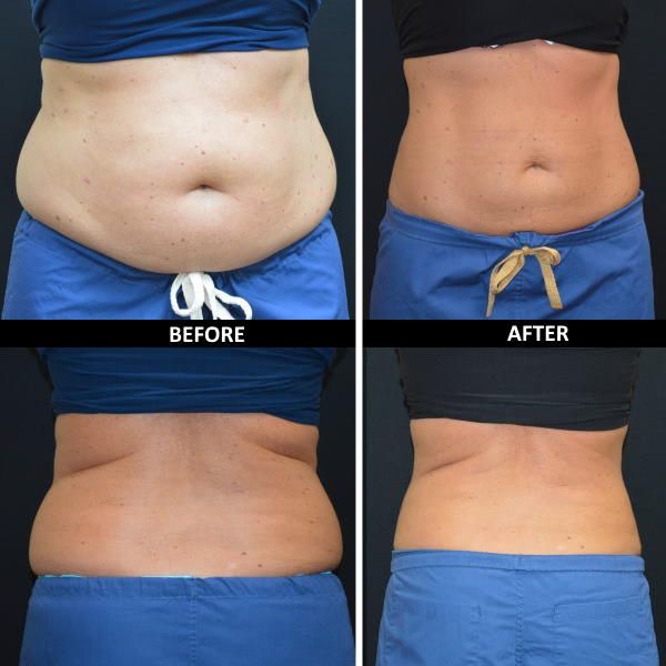 DermPartners's tweet image. Friendly reminder. New Years eve is the final day of our Year End Coolsculpting savings event. Get a jump on that resolution this year and schedule your consultation. As these before and after shots demonstrate. Coolsculpting: can "take yourself further" 561-883-5640