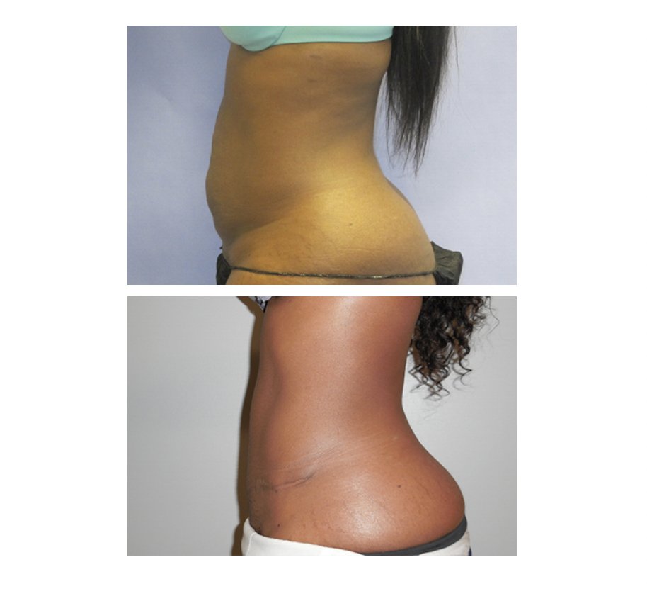 DiFrancescoMD's tweet photo. #Before &amp; #After | Envious of these #tummytuck results? This could be you!
📞(404) 377-3474
🖥️ https://t.co/WEERvDFxSQ
#ATLSurgeon #Liposuction #ATLPlasticSurgeon #PlasticSurgery #Abs #Lipo https://t.co/fIUtojRyBt