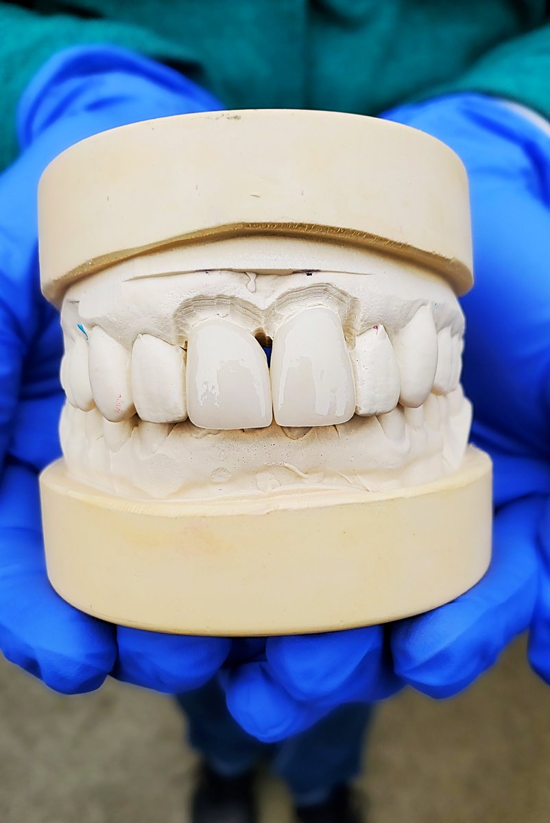Oh the weather outside is frightful, But the sintering furnace is so delightful. And since we've no place to go,
Let It Stain! Let it Glaze! Let it Bake! 
#happyteeth #nakanishidentallab #alliwantforChristmasismy2frontteethmadebyNDL