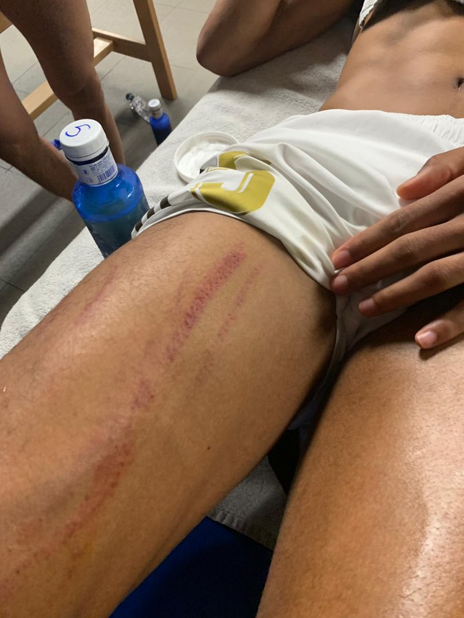 elchiringuitotv's tweet photo. ESCALOFRIANTE.

Así quedó la PIERNA de @raphaelvarane tras la entrada de LENGLET. ¿Por qué NO ENTRÓ el VAR?

¡Lo analizamos a las 23:57h en @elchiringuitotv! https://t.co/z9XyeL7xdZ