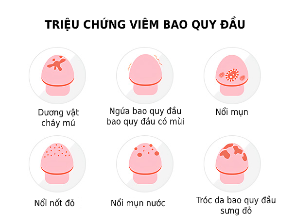 T220894's tweet photo. Dấu hiệu viêm bao quy đầu nam giới cần lưu ý

[https://www. https://t.co/pMsUlYeNni]

#yhocquocte #12kimma #badinh #y_hoc_quoc_te #instagram #baoquydau #bacsygioi #viemnhiem #namgioi #sex #Men #Hanoi #Vietnam #Trump #bokepterbaru #BinanceCollectibles #FinaleWithIrene https://t.co/4xmBbkEx1j
